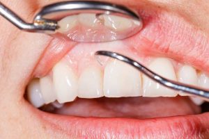periodontitis